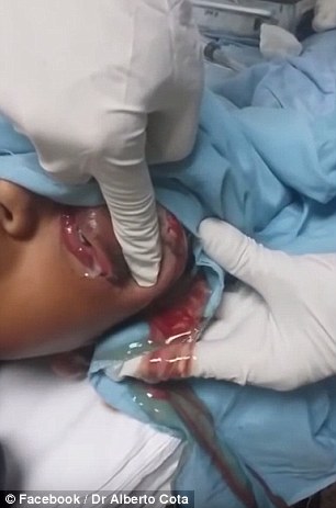 لحظه وحشتناک خارج کردن کیست از چشم کودک 10 ساله + تصاویر