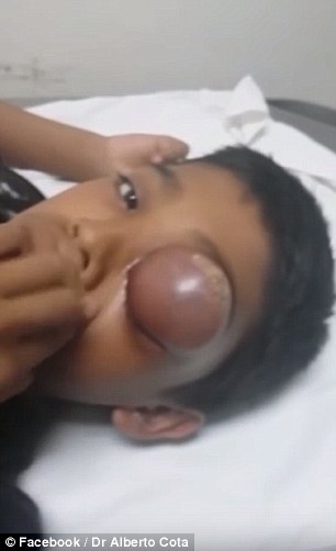 لحظه وحشتناک خارج کردن کیست از چشم کودک 10 ساله + تصاویر