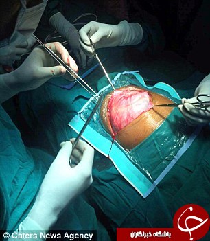 نوزاد دختر هنگام تولد، دوقلو باردار بود+تصاویر