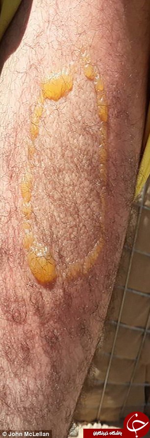 تصاویری تکان دهنده از استفاده داعش از گاز خردل در عراق