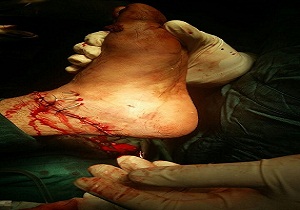 تلاش تیم پزشکی مانع قطع پای مرد میانسال شد