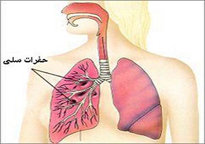 احتمال خطر تبدیل عفونت به بیماری سل