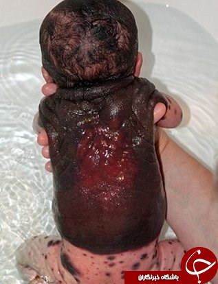 نوزاد خال&zwnj;پشتی که ۲۶ بار جراحی شد! + تصاویر