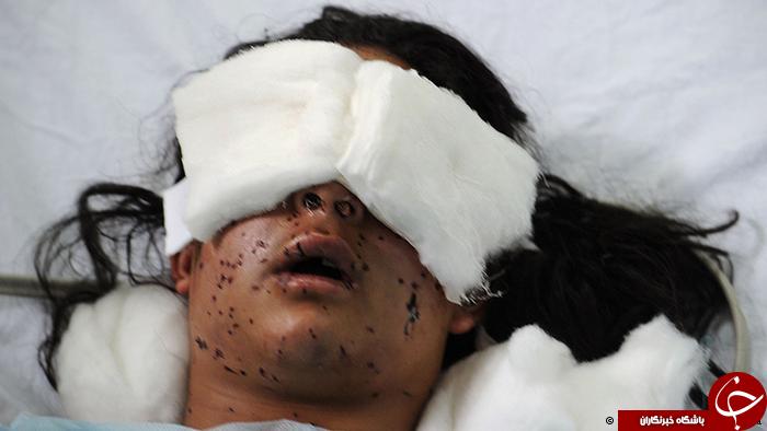 گلوله&zwnj;های فلفل جایگزین گلوله&zwnj;های ساچمه&zwnj;ای در کشمیر/ ساچمه&zwnj;هایی که چشمان معترضان را کور کرد+تصاویر(18+)