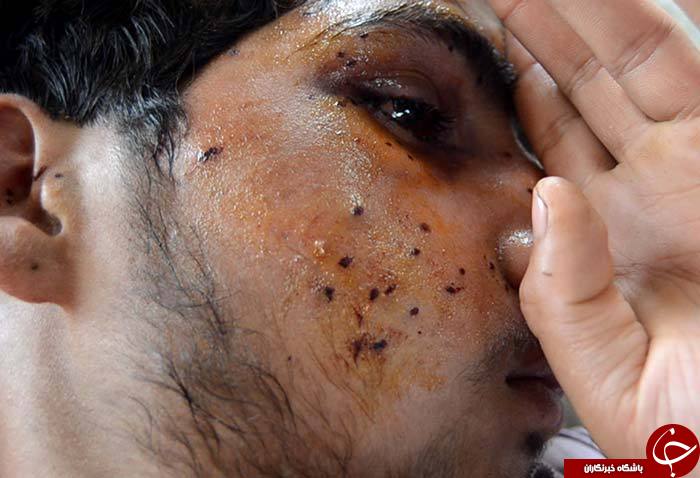 گلوله&zwnj;های فلفل جایگزین گلوله&zwnj;های ساچمه&zwnj;ای در کشمیر/ ساچمه&zwnj;هایی که چشمان معترضان را کور کرد+تصاویر(18+)