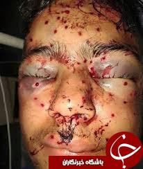 گلوله&zwnj;های فلفل جایگزین گلوله&zwnj;های ساچمه&zwnj;ای در کشمیر/ ساچمه&zwnj;هایی که چشمان معترضان را کور کرد+تصاویر(18+)