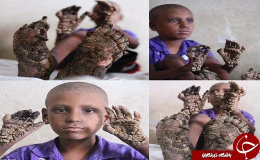 عکس/بیماری نادر پسر بنگلادشی زایده هایی مانند ریشه های درخت!