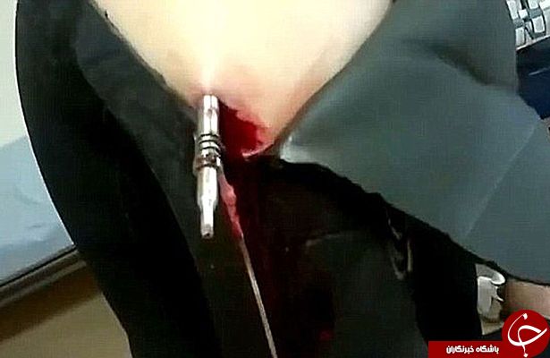 نجات معجزه آسای ماهیگیری که به خودش نِیزه زد!+ تصاویر و فیلم (16+)