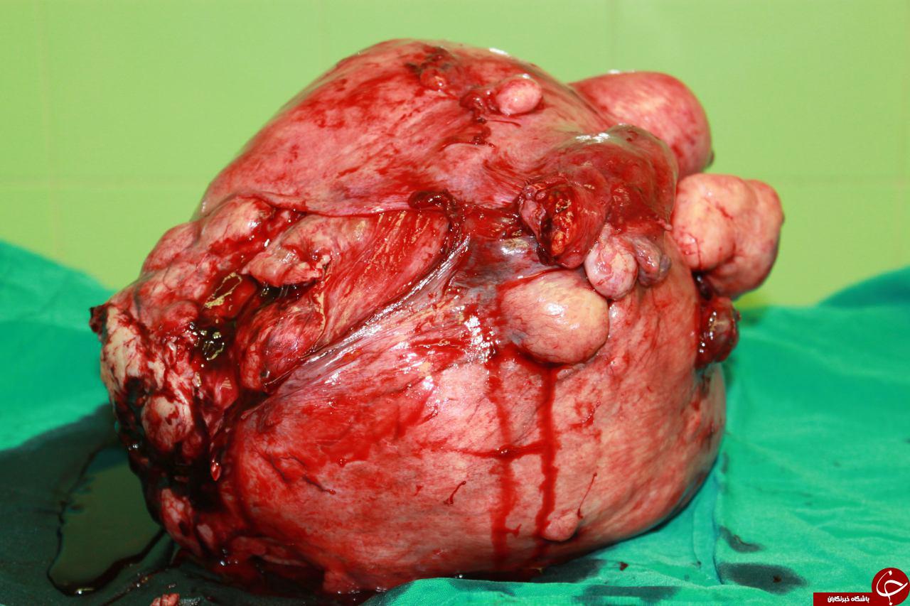 خارج کردن توده 8 کیلوگرمی از شکم خانم 50 ساله+ تصاویر