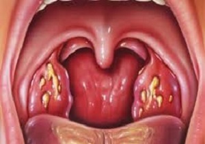 چه مدل لوزه در کودک را باید حتما عمل کرد؟