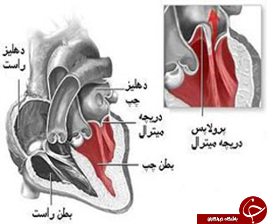پرولاپس یا شلی دریچه میترال قلب چیست؟
