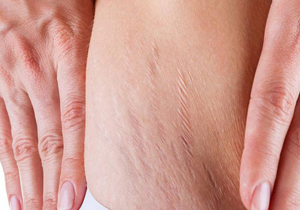 چگونه از کشیدگی‌های پوست خلاص شویم؟