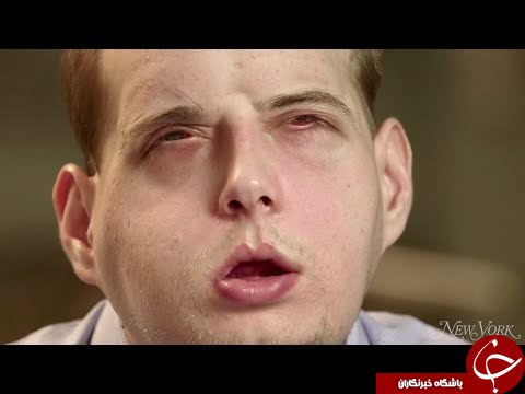 پیام امید آتش نشان فداکار پس  از عمل پیوند صورت