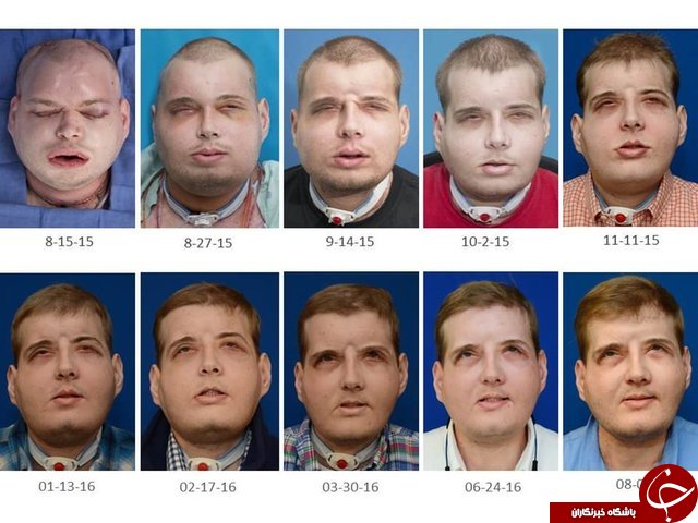 نتیجه بی&zwnj;سابقه&zwnj;ترین پیوند صورت پس از 1 سال+تصاویر