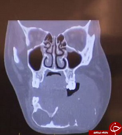 یک تومور به اندازه توپ تنیس در گونه این دختر است +تصاویر