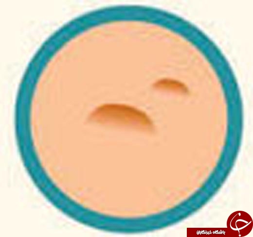 کدام آکنه سراغ تان آمده و چگونه می&zwnj;توانید آن را درمان کنید؟ +عکس