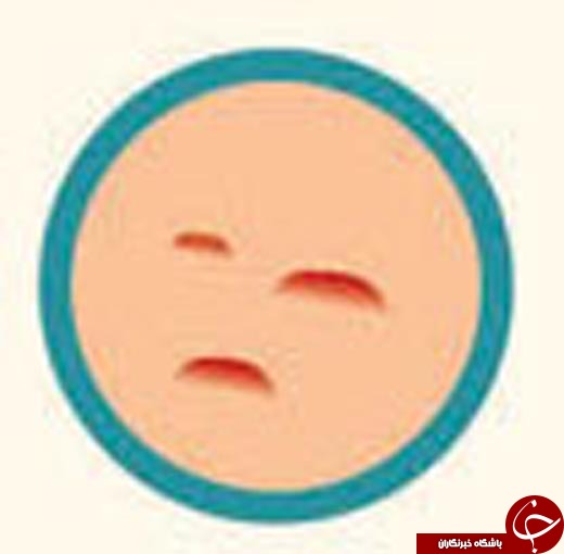 کدام آکنه سراغ تان آمده و چگونه می&zwnj;توانید آن را درمان کنید؟ +عکس