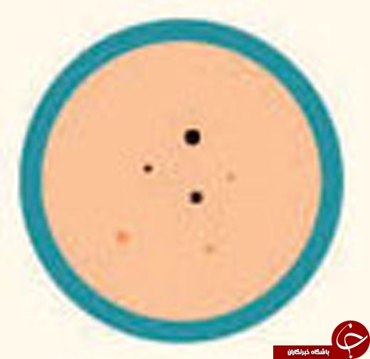 کدام آکنه سراغ تان آمده و چگونه می&zwnj;توانید آن را درمان کنید؟ +عکس