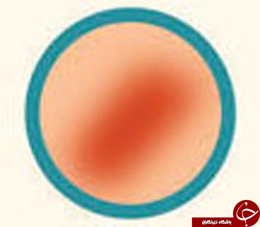کدام آکنه سراغ تان آمده و چگونه می&zwnj;توانید آن را درمان کنید؟ +عکس