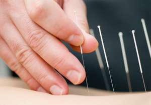 طب سوزنی علائم یائسگی را کاهش می‌دهد