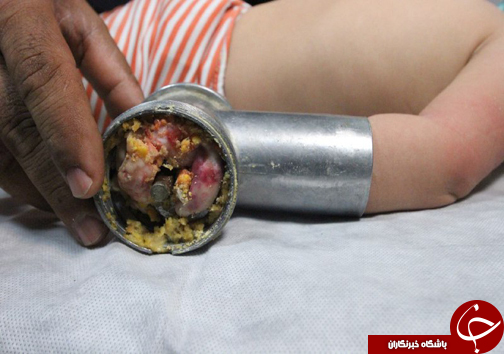 چرخ گوشت دست نوزاد را بلعید