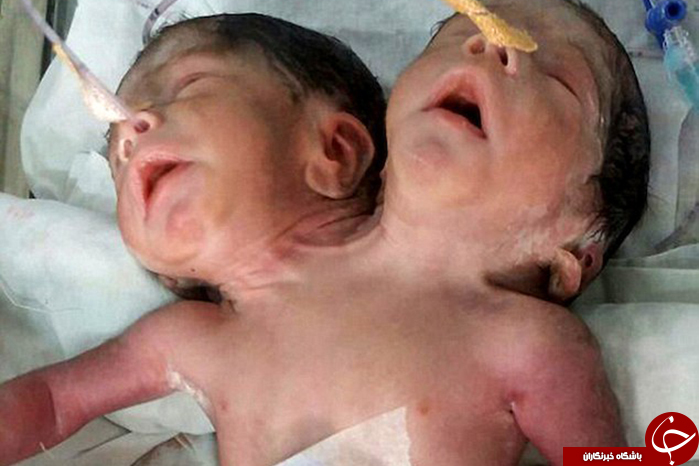 نوزاد دوسر شگفت انگیز هندی فقط 32 ساعت زنده ماند