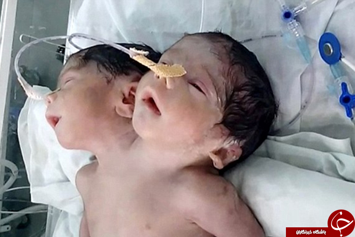 نوزاد دوسر شگفت انگیز هندی فقط 32 ساعت زنده ماند