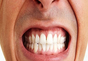 علت دندان قروچه چیست؟