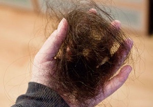 خارج کردن بزرگترین توده مو از معده زن 36 ساله + تصاویر