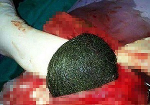 خارج کردن بزرگترین توده مو از معده زن 36 ساله + تصاویر