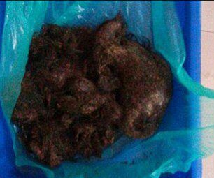خارج کردن بزرگترین توده مو از معده زن 36 ساله + تصاویر