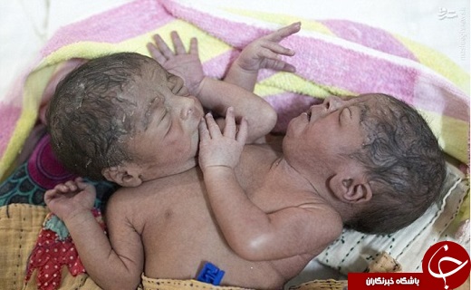 تصاویری از تولد دوقلوی به هم چسبیده در بنگلادش
