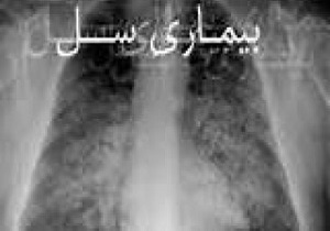 کرمانشاه یکی از قطب های تشخیص سل در غرب کشور