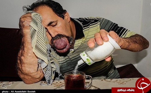 تصاویری از بیماری گشادی رگهای خونی اسماعیل