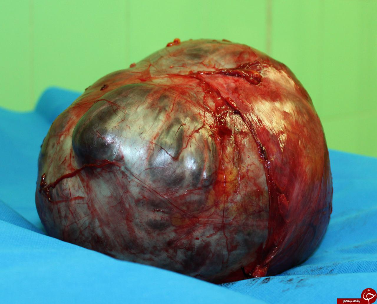 خارج کردن توده 5 کیلوگرمی از شکم خانم 42 ساله+تصاویر
