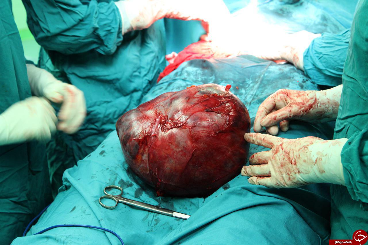 خارج کردن توده 5 کیلوگرمی از شکم خانم 42 ساله+تصاویر