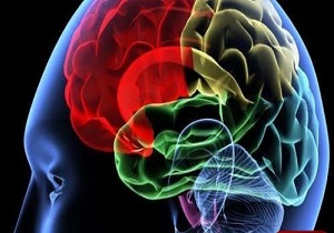 سن پایین سکته مغزی در کشور / هنگام بروز سکته مغزی چه باید کرد؟