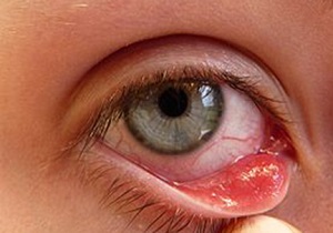 عینک مطمئن‌ترین وسیله برای درمان بیماری‌های چشمی/ بیش از 7 هزار پیوند قرنیه در سال گذشته انجام شده است