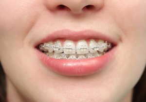 باورهای اشتباه درباره ارتودنسی