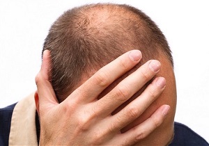 ترفندهایی برای جلوگیری از ریزش مو/ ریزش مو در جوانان 50 درصد زمینه ژنتیکی دارد