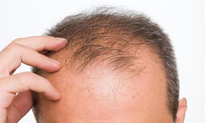 پسرانی که موهای کم پشتی دارند، حتما بخوانند+ راه پیشگیری