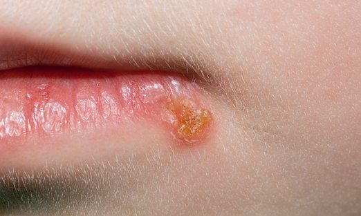چگونه با تبخال مقابله کنیم؟