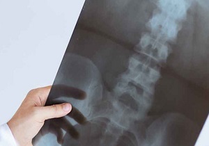 تیر خلاص قرص‌های اعصاب بر استخوان بیماران/ هر آنچه درباره پوکی استخوان باید دانست