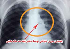سوزن خیاطی در نای دختر بچه بابلی