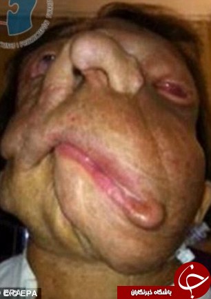 پیوند صورت زندگی را به این زن بازگرداند +تصاویر