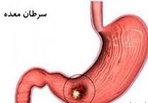 شایع ترین بیماری در استان سرطان معده است