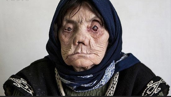 ناگفته هایی هولناک از بیماران جذامی/ جذامی ها کجا زندگی می کنند؟(+18)