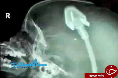 خارج کردن سه&zwnj;شاخه کابل برق از سر یک کودک ۲ ساله +عکس