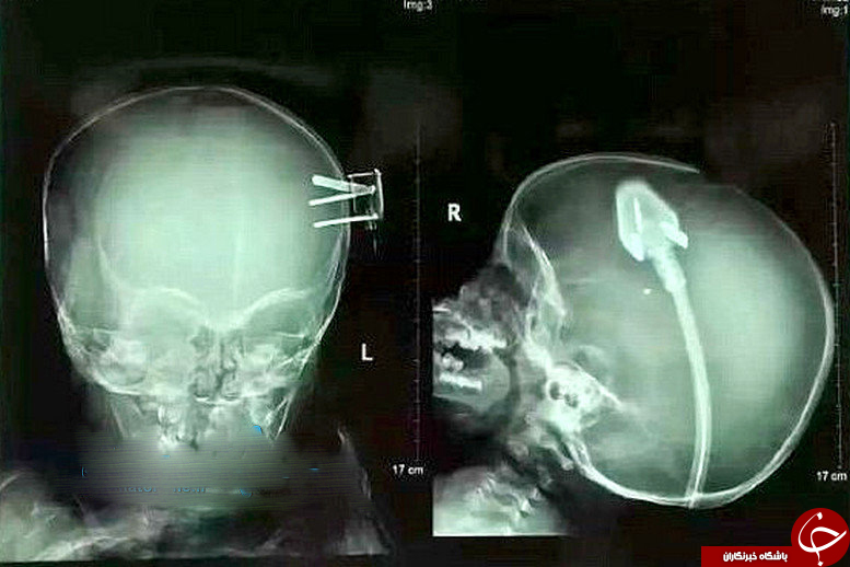 خارج کردن سه&zwnj;شاخه کابل برق از سر یک کودک ۲ ساله +عکس