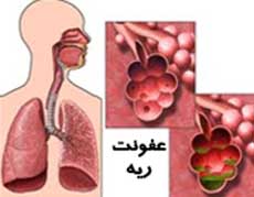 ایجاد بانک اطلاعاتی بیماران ریوی در خراسان رضوی